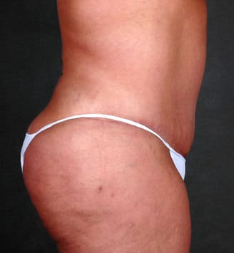 breast reduction - patient 5922 - after 6 breast reduction - patient 5922 - after 6