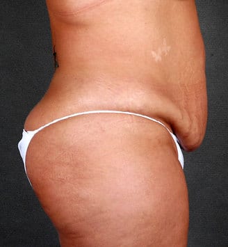 breast reduction - patient 5922 - before 6 breast reduction - patient 5922 - before 6