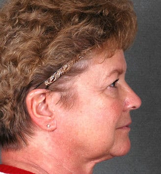 blepharoplasty - patient 5271 - after 3 blepharoplasty - patient 5271 - after 3