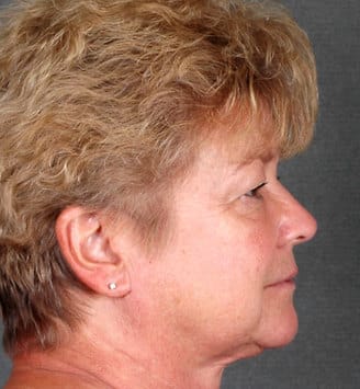 blepharoplasty - patient 5271 - before 3 blepharoplasty - patient 5271 - before 3