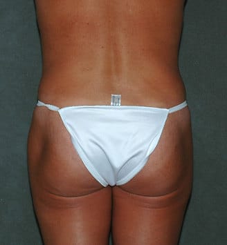 breast augmentation - patient 4943 - before 4 breast augmentation - patient 4943 - before 4