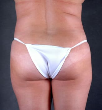 breast augmentation - patient 4943 - after 4 breast augmentation - patient 4943 - after 4