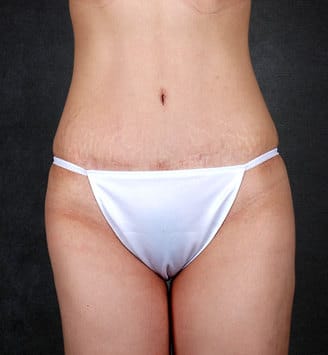 breast augmentation - patient 5125 - after 6 breast augmentation - patient 5125 - after 6