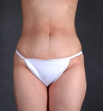 mommy makeover - patient 4677 - before 6 mommy makeover - patient 4677 - before 6