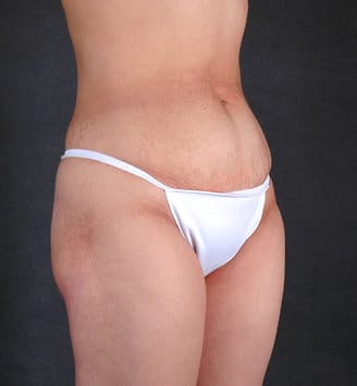 mommy makeover - patient 4677 - before 7 mommy makeover - patient 4677 - before 7