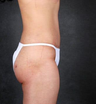 breast augmentation - patient 5125 - after 8 breast augmentation - patient 5125 - after 8