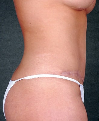 breast lift - patient 5681 - after 2 breast lift - patient 5681 - after 2