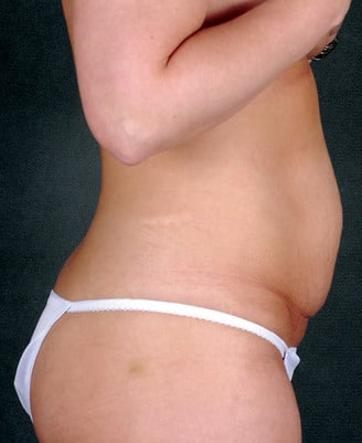 breast lift - patient 5681 - before 2 breast lift - patient 5681 - before 2