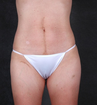breast augmentation - patient 5339 - after 4 breast augmentation - patient 5339 - after 4