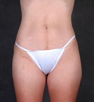 mommy makeover - patient 4558 - before 4 mommy makeover - patient 4558 - before 4