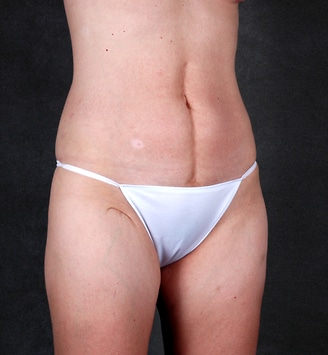 breast augmentation - patient 5339 - after 5 breast augmentation - patient 5339 - after 5