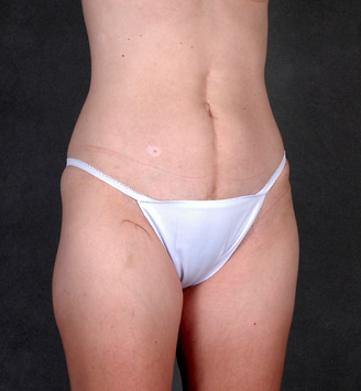 mommy makeover - patient 4558 - before 5 mommy makeover - patient 4558 - before 5
