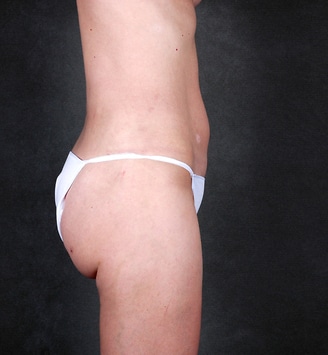 breast augmentation - patient 5339 - after 6 breast augmentation - patient 5339 - after 6