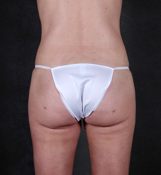 breast augmentation - patient 5339 - after 7 breast augmentation - patient 5339 - after 7