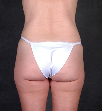 mommy makeover - patient 4558 - before 7 mommy makeover - patient 4558 - before 7