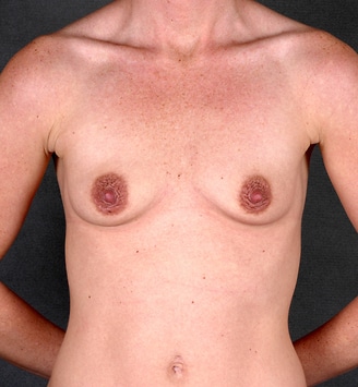 breast augmentation - patient 4934 - before 1 breast augmentation - patient 4934 - before 1