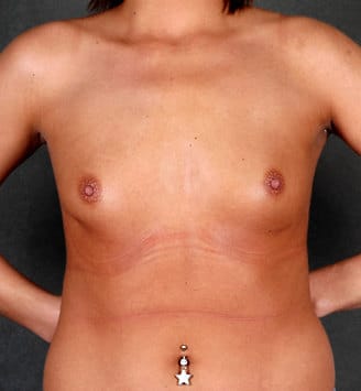 breast augmentation - patient 5159 - before 1 breast augmentation - patient 5159 - before 1