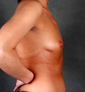breast augmentation - patient 5159 - before 3 breast augmentation - patient 5159 - before 3