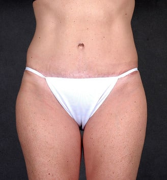 tummy tuck - patient 4950 - after 1 tummy tuck - patient 4950 - after 1
