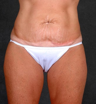 tummy tuck - patient 4950 - before 1 tummy tuck - patient 4950 - before 1