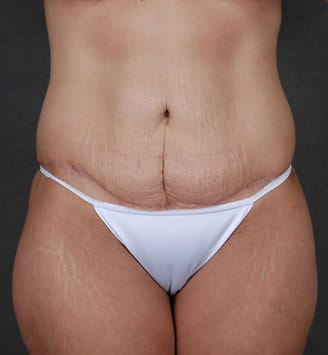 breast lift - patient 5626 - after 4 breast lift - patient 5626 - after 4