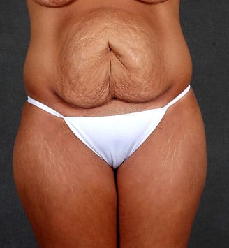 breast lift - patient 5626 - before 4 breast lift - patient 5626 - before 4
