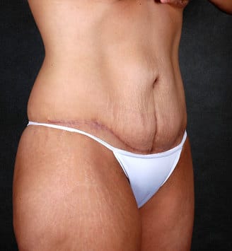 breast lift - patient 5626 - after 5 breast lift - patient 5626 - after 5