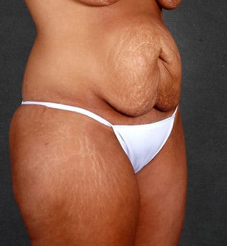 breast lift - patient 5626 - before 5 breast lift - patient 5626 - before 5