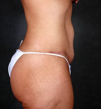 breast lift - patient 5626 - after 6 breast lift - patient 5626 - after 6