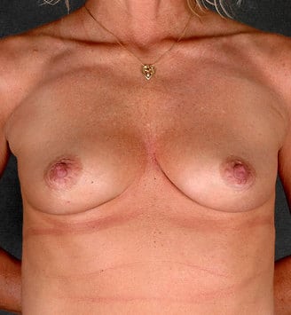 breast augmentation - patient 5201 - before 1 breast augmentation - patient 5201 - before 1