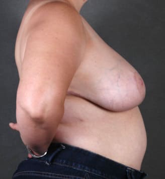 breast reduction - patient 5973 - after 3 breast reduction - patient 5973 - after 3