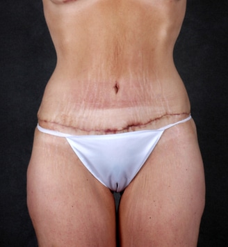 tummy tuck - patient 4899 - after 4 tummy tuck - patient 4899 - after 4