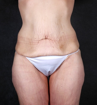 mommy makeover - patient 4698 - before 4 mommy makeover - patient 4698 - before 4