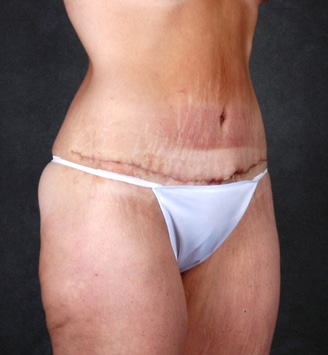 mommy makeover - patient 4698 - after 5 mommy makeover - patient 4698 - after 5