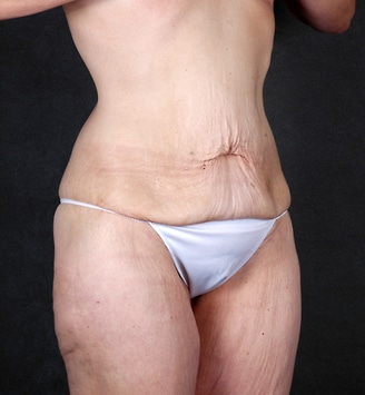 mommy makeover - patient 4698 - before 5 mommy makeover - patient 4698 - before 5