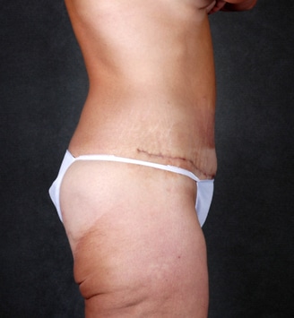 tummy tuck - patient 4899 - after 6 tummy tuck - patient 4899 - after 6