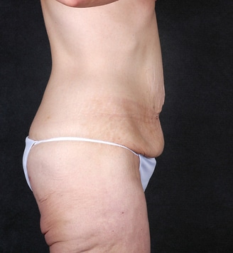 mommy makeover - patient 4698 - before 6 mommy makeover - patient 4698 - before 6