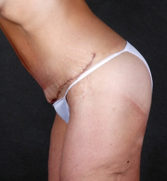 tummy tuck - patient 4899 - after 7 tummy tuck - patient 4899 - after 7