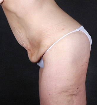 tummy tuck - patient 4899 - before 7 tummy tuck - patient 4899 - before 7