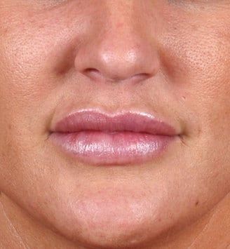 juvéderm - patient 6084 - after 1 juvéderm - patient 6084 - after 1