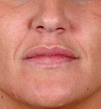 juvéderm - patient 6084 - before 1 juvéderm - patient 6084 - before 1