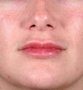 juvéderm - patient 6090 - after 1 juvéderm - patient 6090 - after 1