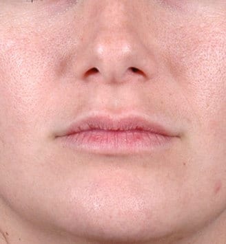 juvéderm - patient 6090 - before 1 juvéderm - patient 6090 - before 1