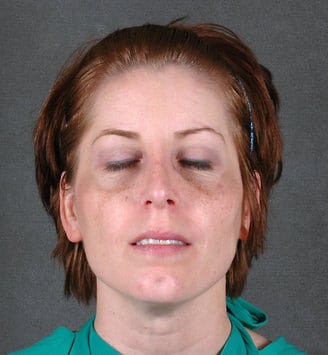 rhinoplasty - patient 5784 - after 1 rhinoplasty - patient 5784 - after 1