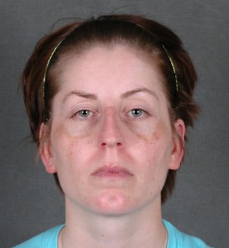 rhinoplasty - patient 5784 - before 1 rhinoplasty - patient 5784 - before 1