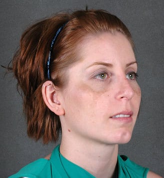 rhinoplasty - patient 5784 - after 2 rhinoplasty - patient 5784 - after 2