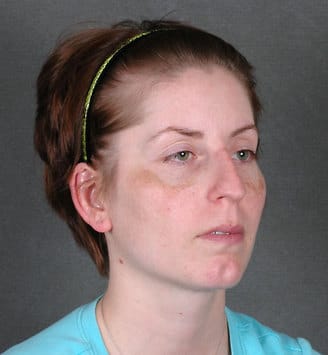 rhinoplasty - patient 5784 - before 2 rhinoplasty - patient 5784 - before 2