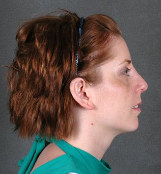 rhinoplasty - patient 5784 - after 3 rhinoplasty - patient 5784 - after 3