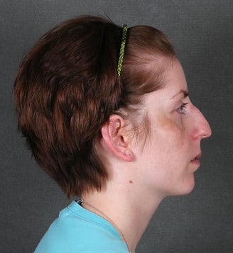 rhinoplasty - patient 5784 - before 3 rhinoplasty - patient 5784 - before 3