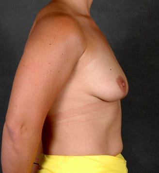 breast augmentation - patient 5367 - before 3 breast augmentation - patient 5367 - before 3